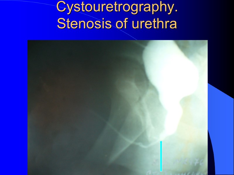 Cystouretrography. Stenosis of urethra Cystouretrography. Stenosis of urethra